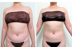 スピードダイエット上半身
