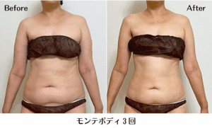 モンテビフォーアフター