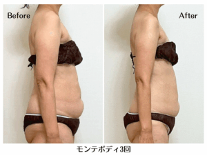 モンテビフォーアフター