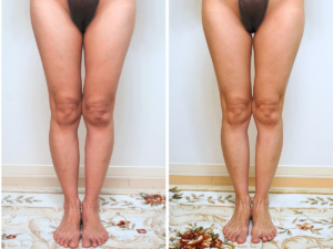 フェレナスパッツビフォーアフター