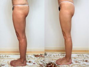 フェレナスパッツビフォーアフター