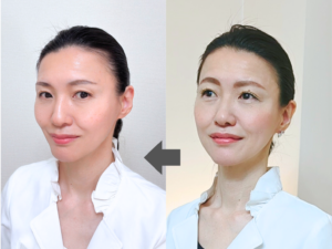 頭蓋骨Mビフォーアフター